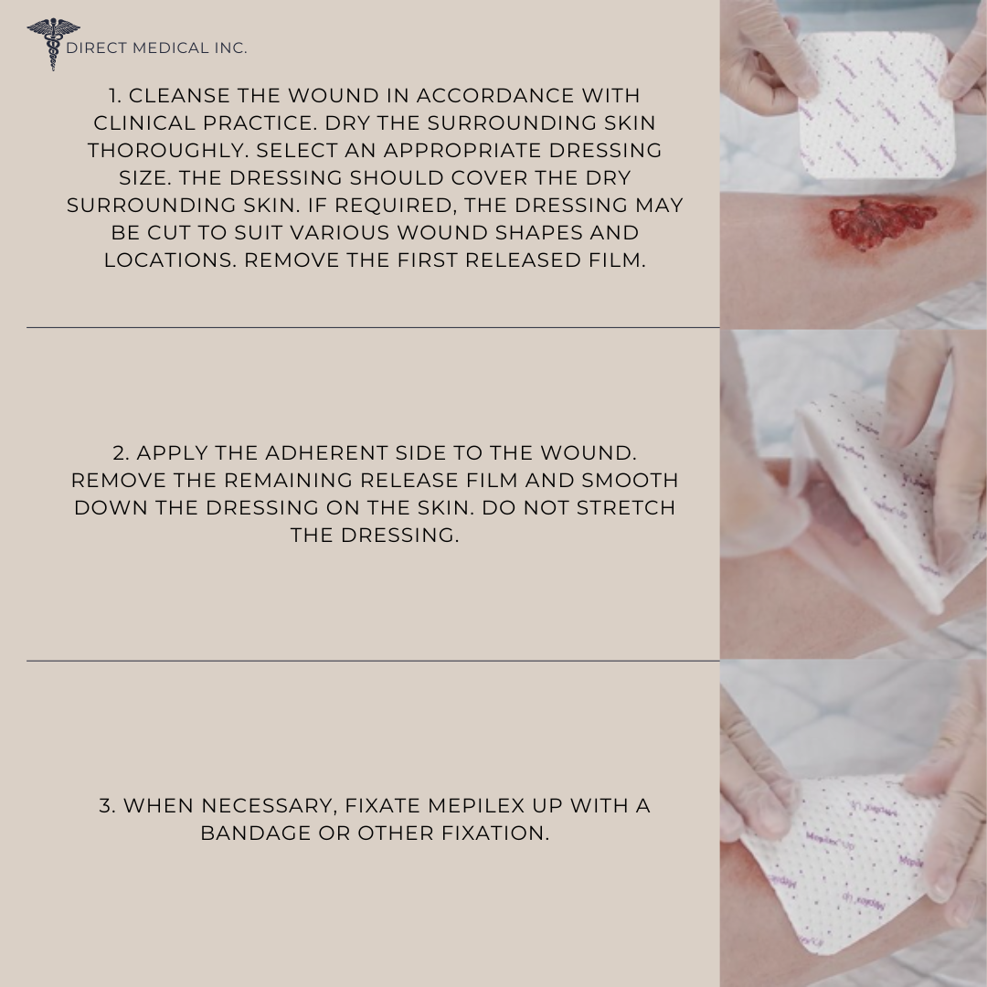 How to Apply Mepilex Up Non-Bordered Foam Dressing