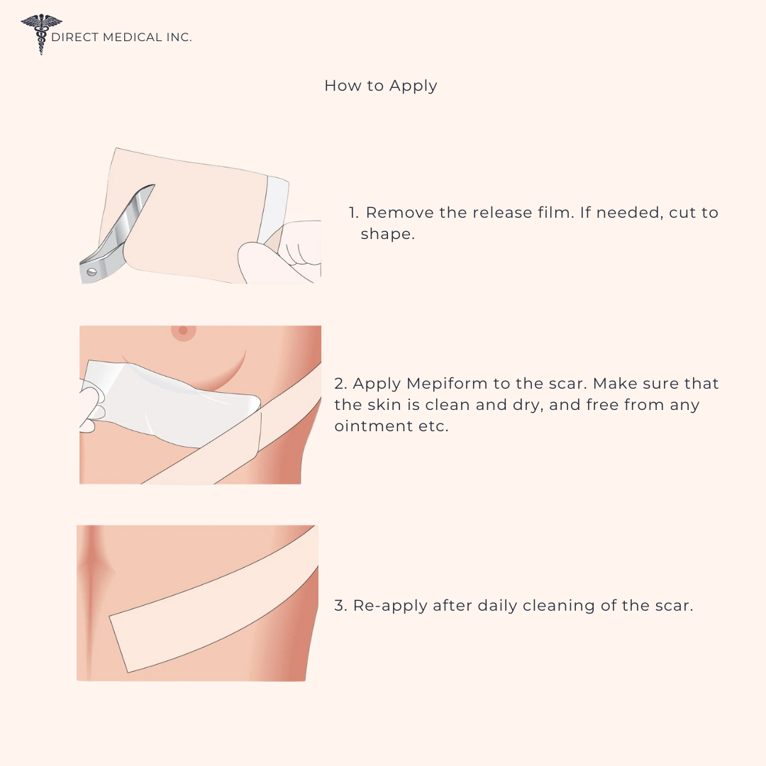 Mepiform How to Apply; 1. Remove the release film. If needed, cut to shape. 2. Apply Mepifom to the scar. Make sure that the skin is clean and dry, and free from any ointment etc. 3. Re-apply after daily cleaning of the scar. | Direct Medical Inc.