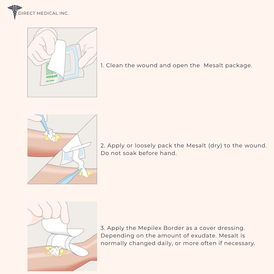 Using Mesalt Mölnlycke Mesalt Sodium Chloride Dressing 286080, 8”x8” - Direct ...